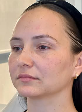 Antes do tratamento de harmonização facial