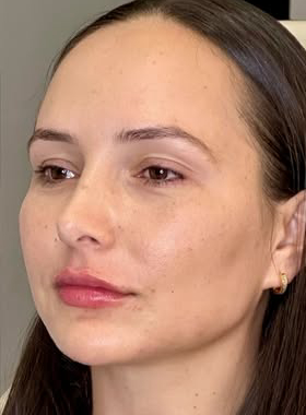 Depois do tratamento de harmonização facial