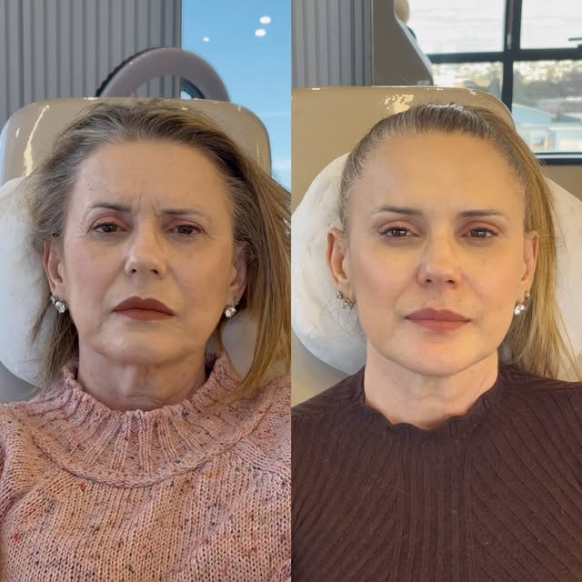 Antes e depois — harmonização facial