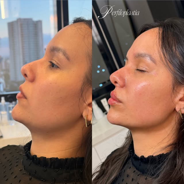 Antes e depois — harmonização facial
