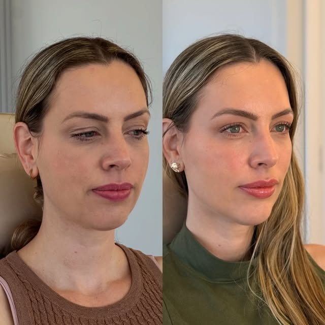Antes e depois — rejuvenescimento facial