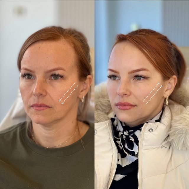 Antes e depois — contorno facial