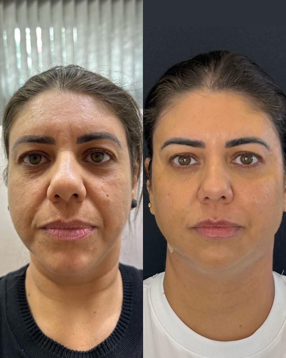 Antes e depois — rejuvenescimento facial