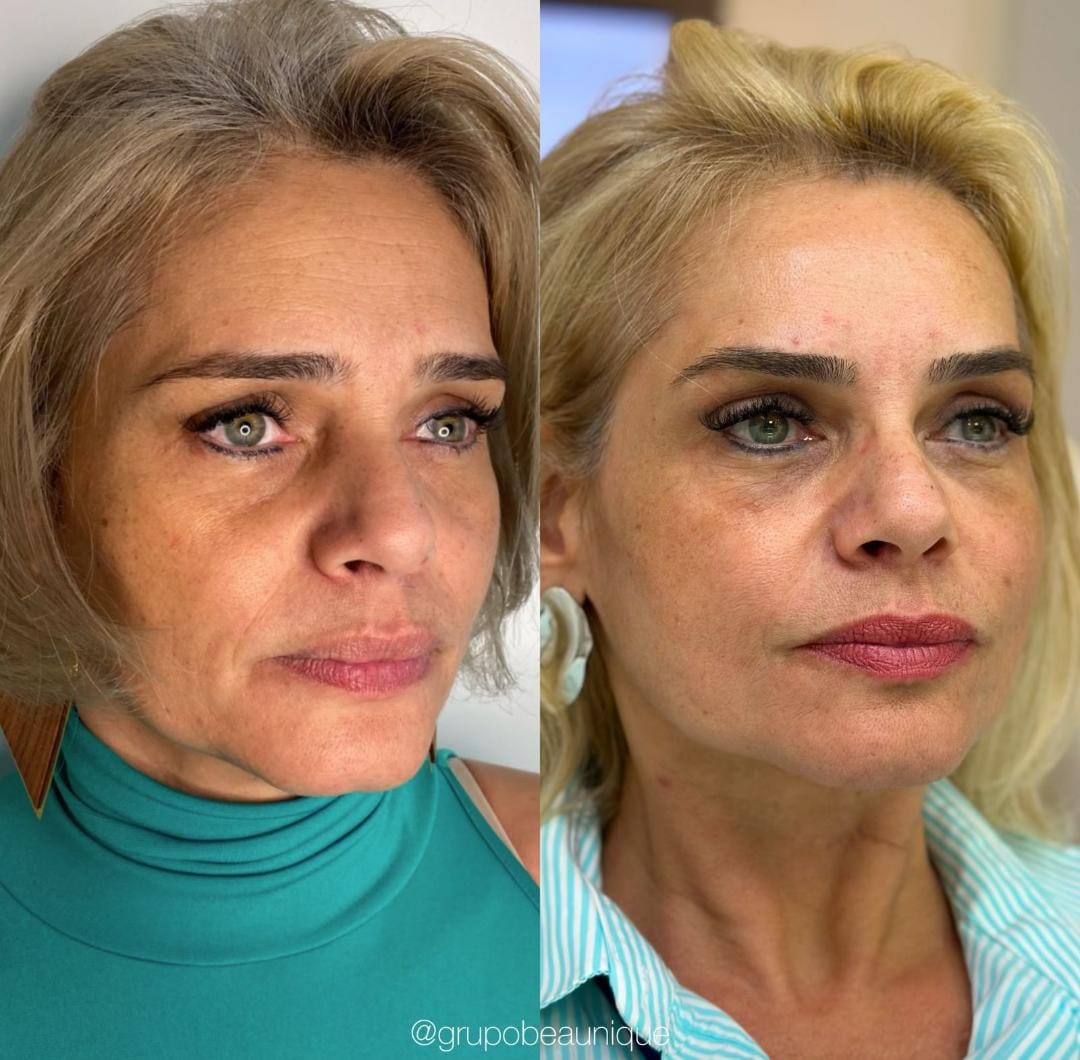 Antes e depois — harmonização facial